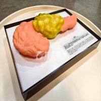 胰腺癌